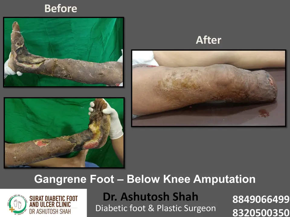 Diabetic Foot  PPT 3 checked by sir.pptx-30.webp